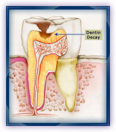 Caries - Dentin