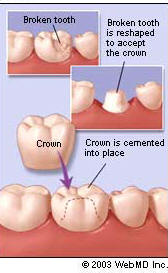 Dental Health - Crowns